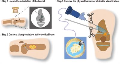 Physeal bar resection by modified arthroscopically assisted surgery in a closed osteocavity